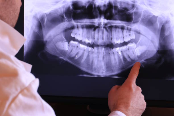 Best Knocked-Out Tooth (Avulsed Tooth) Treatment in Portola, CA
