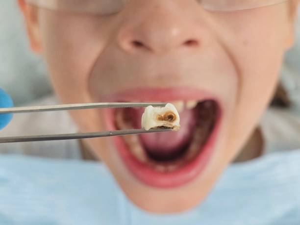 Best Dental Abscess Treatment in Portola, CA
